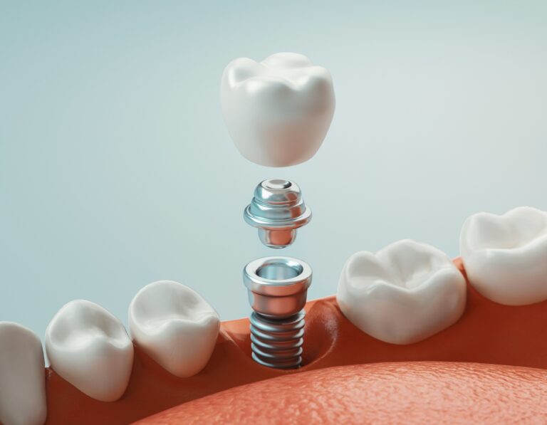 Dental Implants in Raleigh, NC at Village Dental