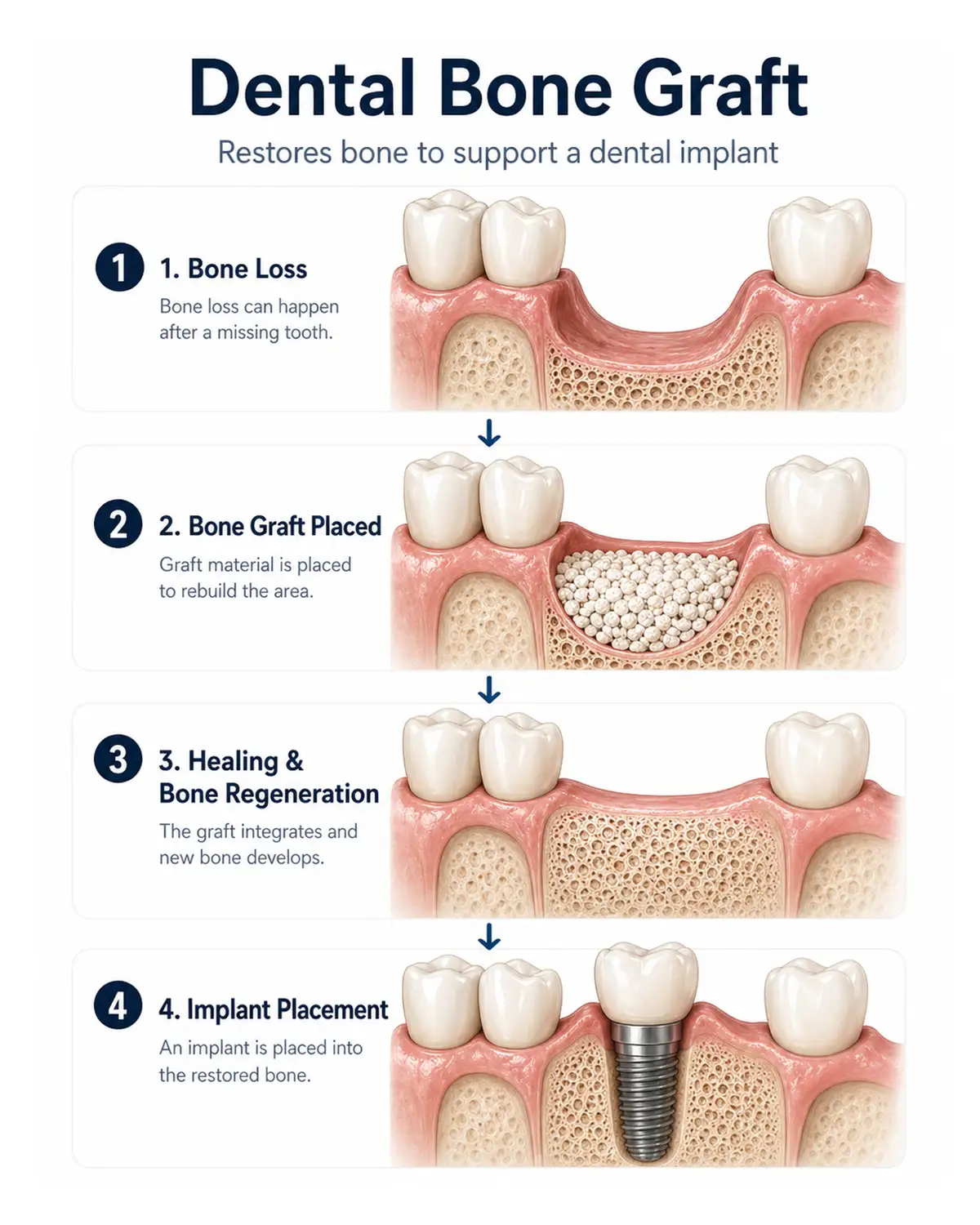 Close-up of dental bone graft materials and surgical tools used during ridge augmentation at Village Dental North Raleigh, NC