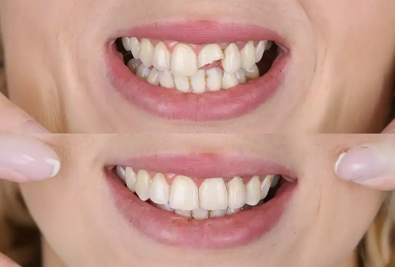 Close-up of a chipped front tooth being repaired with composite dental bonding at Village Dental in Wake Forest, NC