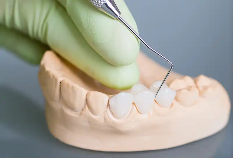 Close-up of modern porcelain and zirconia dental bridge material used to fabricate a custom dental bridge at Village Dental North Raleigh