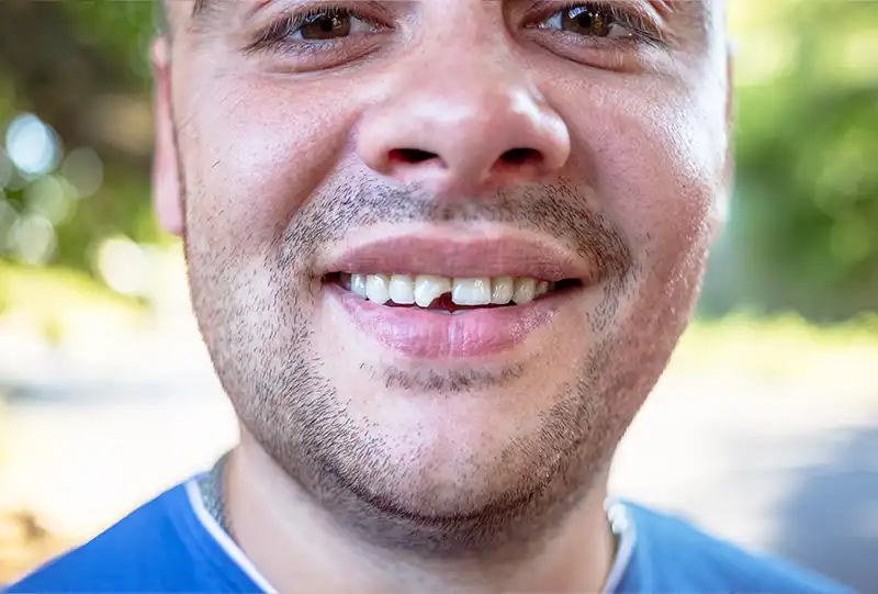 Close-up of completed porcelain veneers transforming a smile at Village Dental Wake Forest, NC