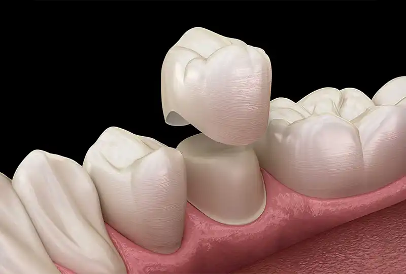 Close-up of a porcelain dental crown being fitted onto a prepared tooth at Village Dental in Olde Raleigh, Raleigh, NC
