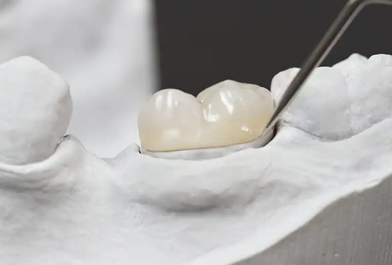 Digital intraoral scan of a prepared molar being captured for a custom porcelain inlay at Village Dental Brier Creek