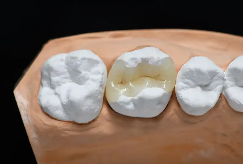 Custom porcelain onlay being placed on a back molar during a restorative dental visit at Village Dental Wake Forest