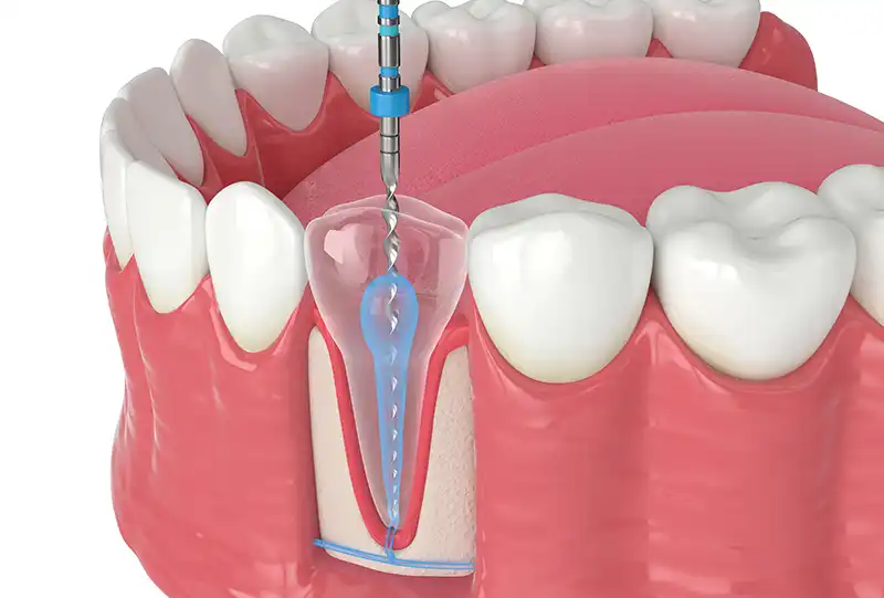 3D cone-beam dental scan and rotary endodontic instruments used for precise root canal treatment at Village Dental Brier Creek, Raleigh, NC