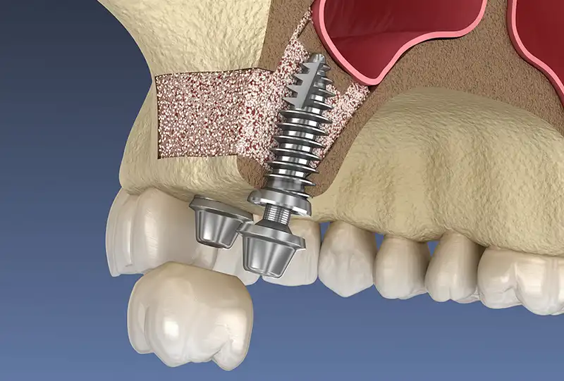 3D dental imaging used to plan sinus lift and dental implant placement at Village Dental Wake Forest