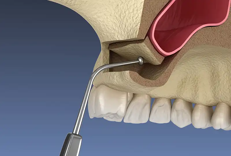 Cone-beam CT scan showing the upper jaw and maxillary sinus during sinus augmentation planning at Village Dental in Wake Forest, NC