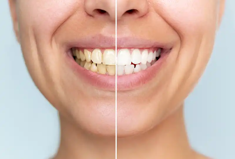 Patient comparing tooth shade with a whitening shade guide during a teeth whitening visit at Village Dental in Wake Forest, NC